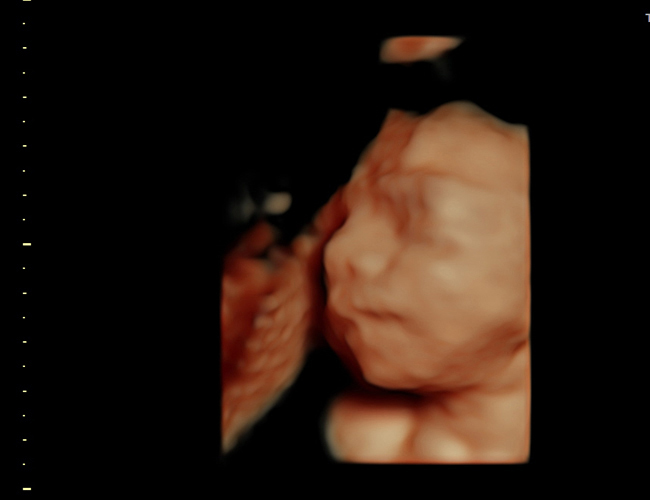 3D ultrasound image at 25 weeks